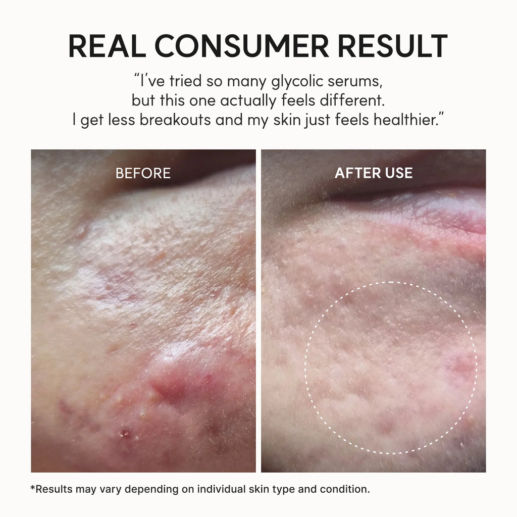 Acne Prone Skin Exfoliating Serum