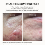 Acne Prone Skin Exfoliating Serum