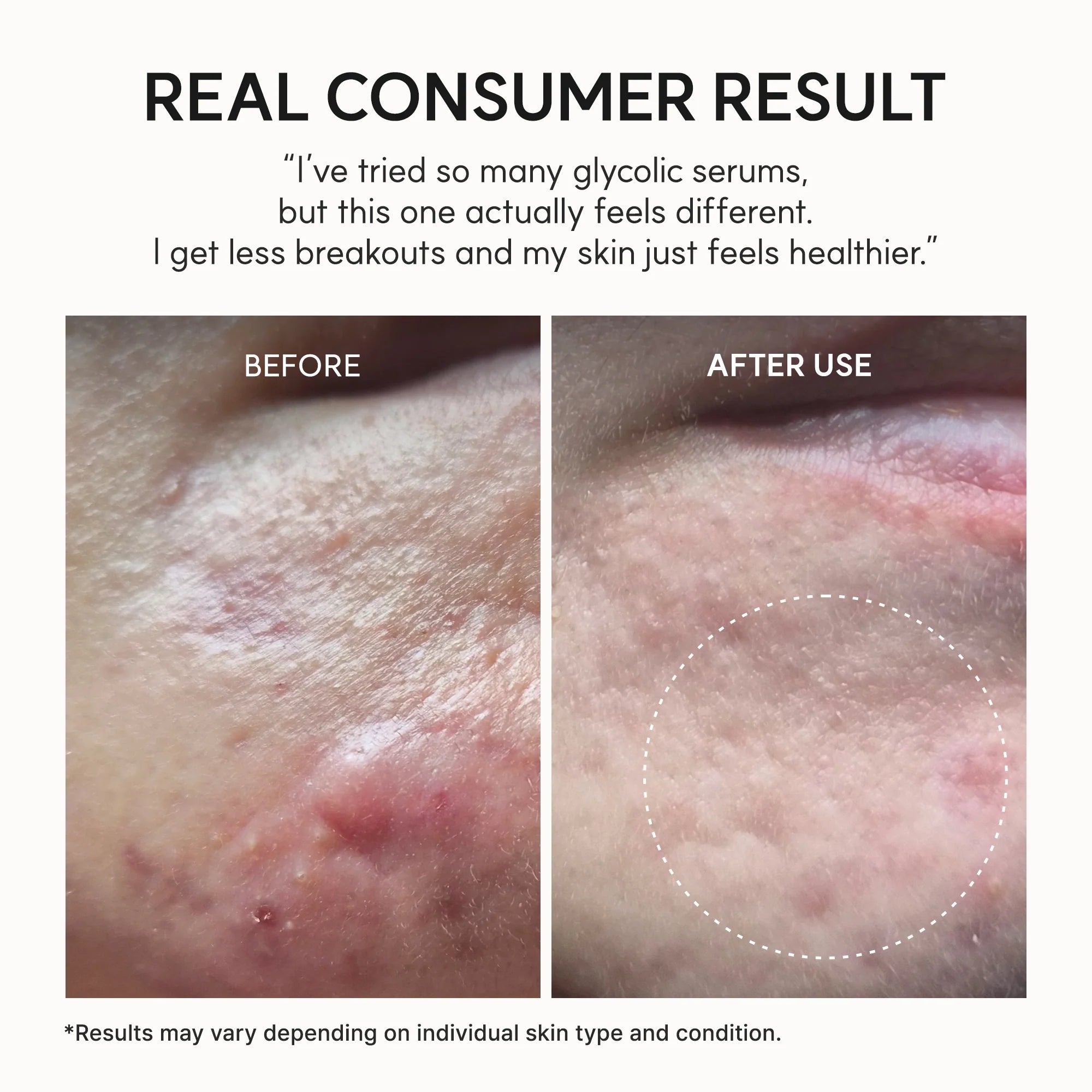 Acne Prone Skin Exfoliating Serum