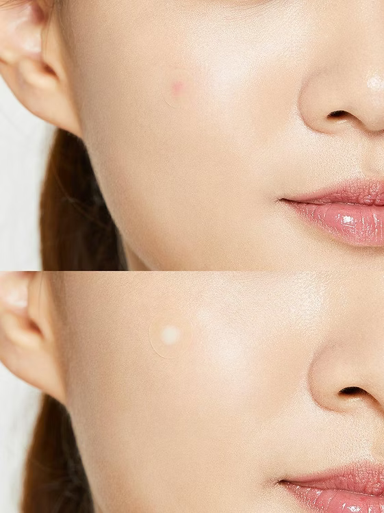 Cosrx - Acne Pimple Master Patch - Beauty Station by Rafia